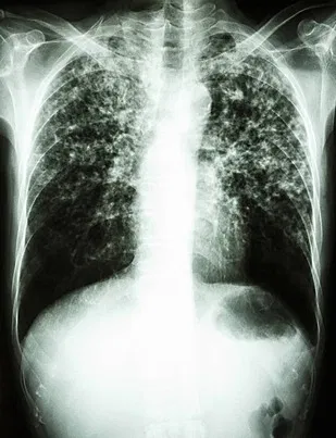 Avatar of Mycobacterium TB